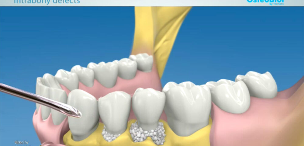 El objetivo primordial de la regeneración periodontal es la restitución