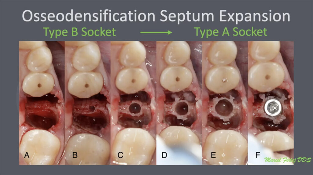 Expansión y oseodensificación guiada implantación en el septum Total